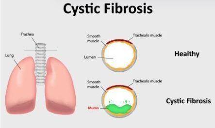 Cystic fibrosis affects about 200,000 people in the united states.  a. true  b. false