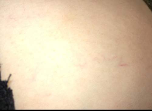 What are these little red veins i have on the side of my ribs, theyre small and almost not noticeabl