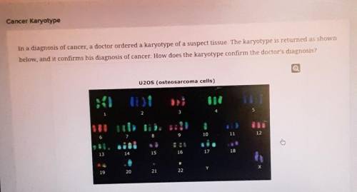 In a diagnosis of cancer, a doctor ordered a karyotype of a suspect tissue, The karyotype is returne