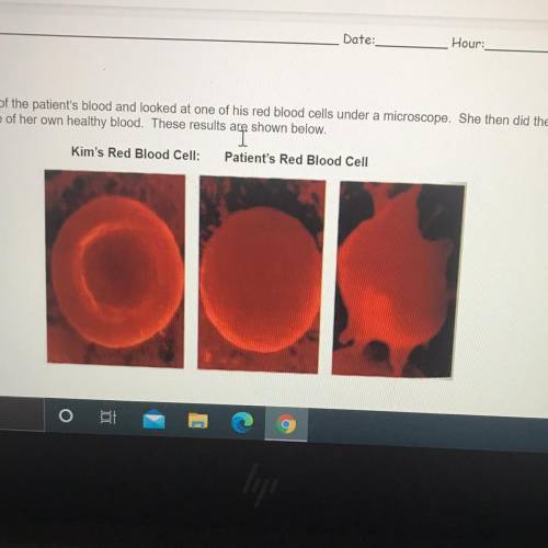 How does Kim’s red blood cell appear different from the patient’s? Why is this the case?