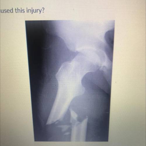 Answer the following questions using the x ray picture below:

 
1. what are present in this x ray?