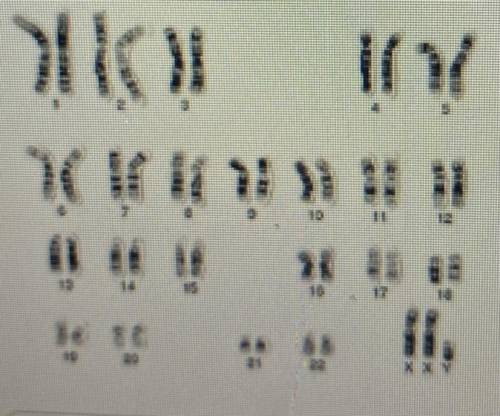 1. Patient B:

Using the karyotype below and the chart from the last screen:
A. Determine the sex