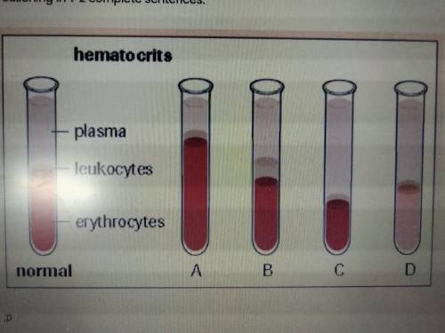 20) Cancer of the white blood cells is called leukemia. Like other cancers, leukemia is associated